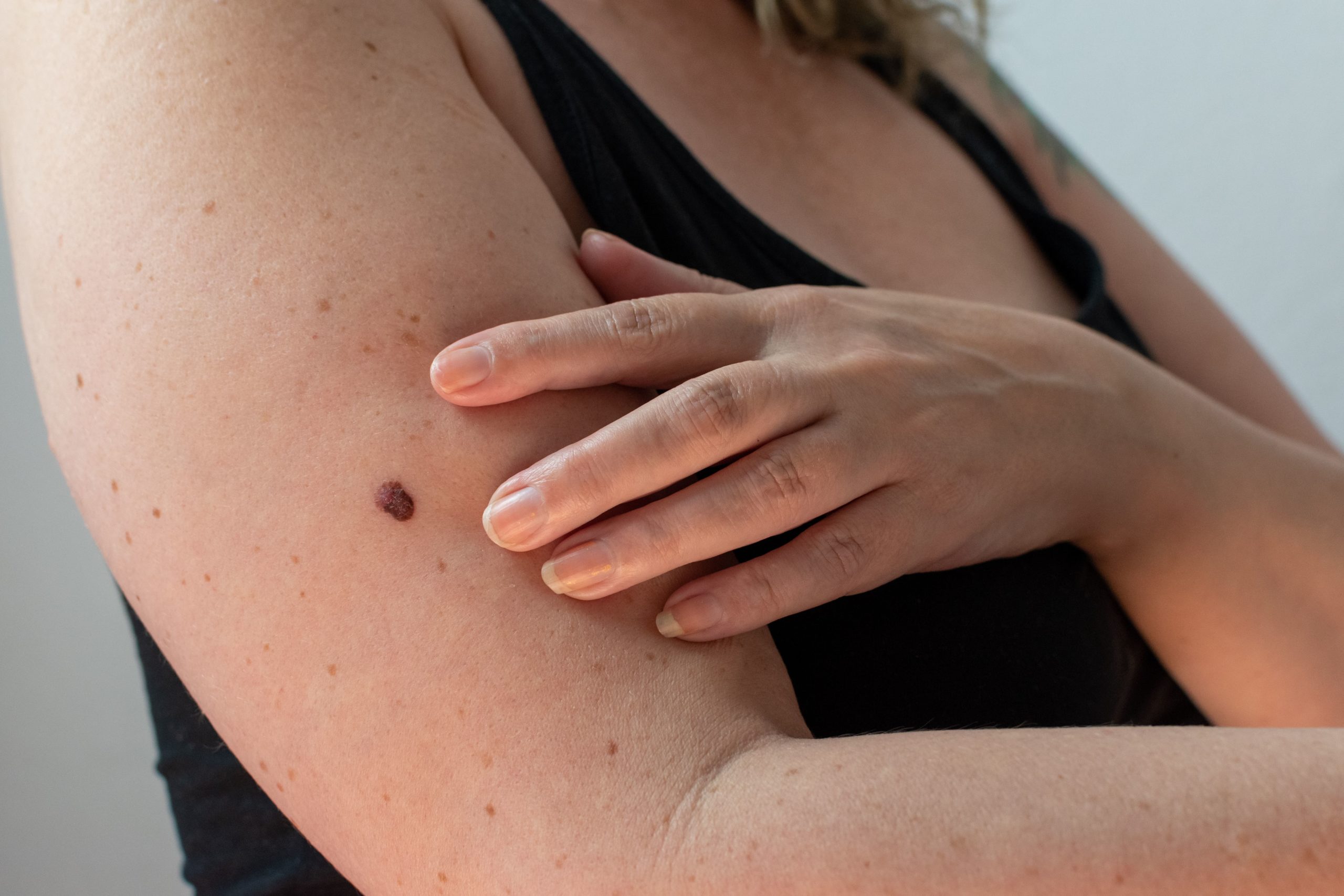 Melanoma