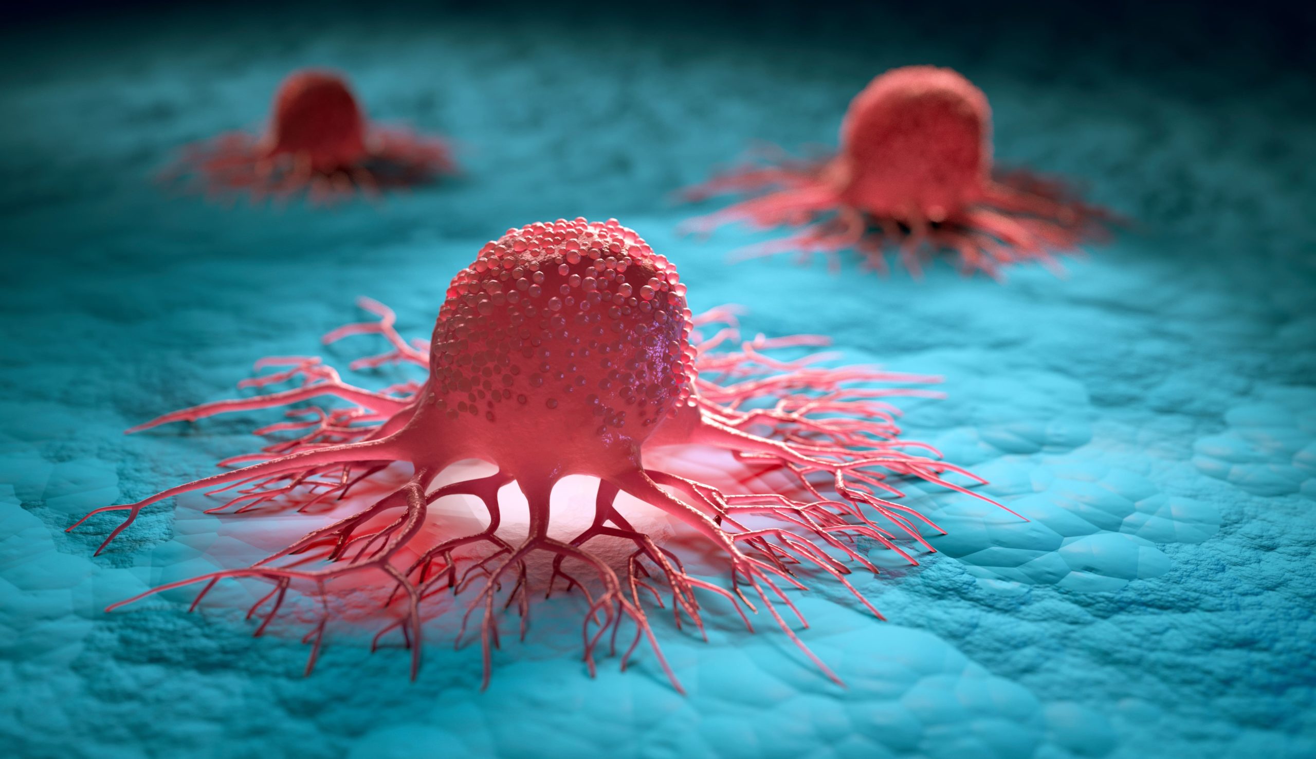 Adenocarcinoma