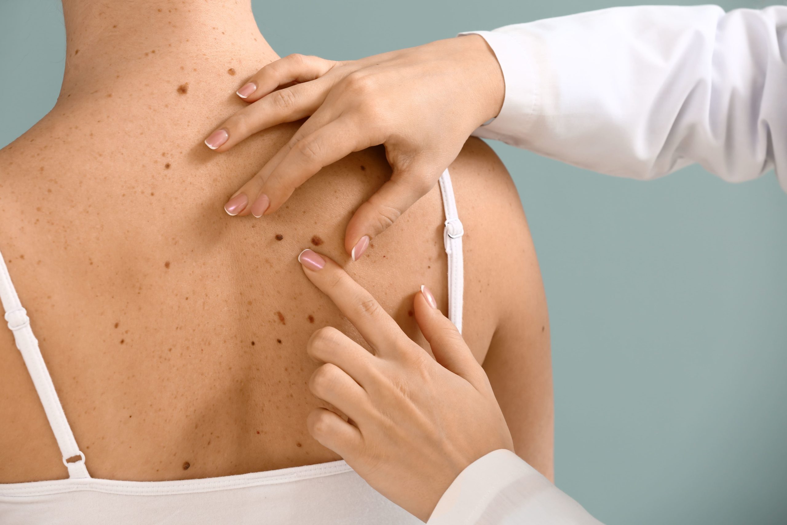 Melanoma
