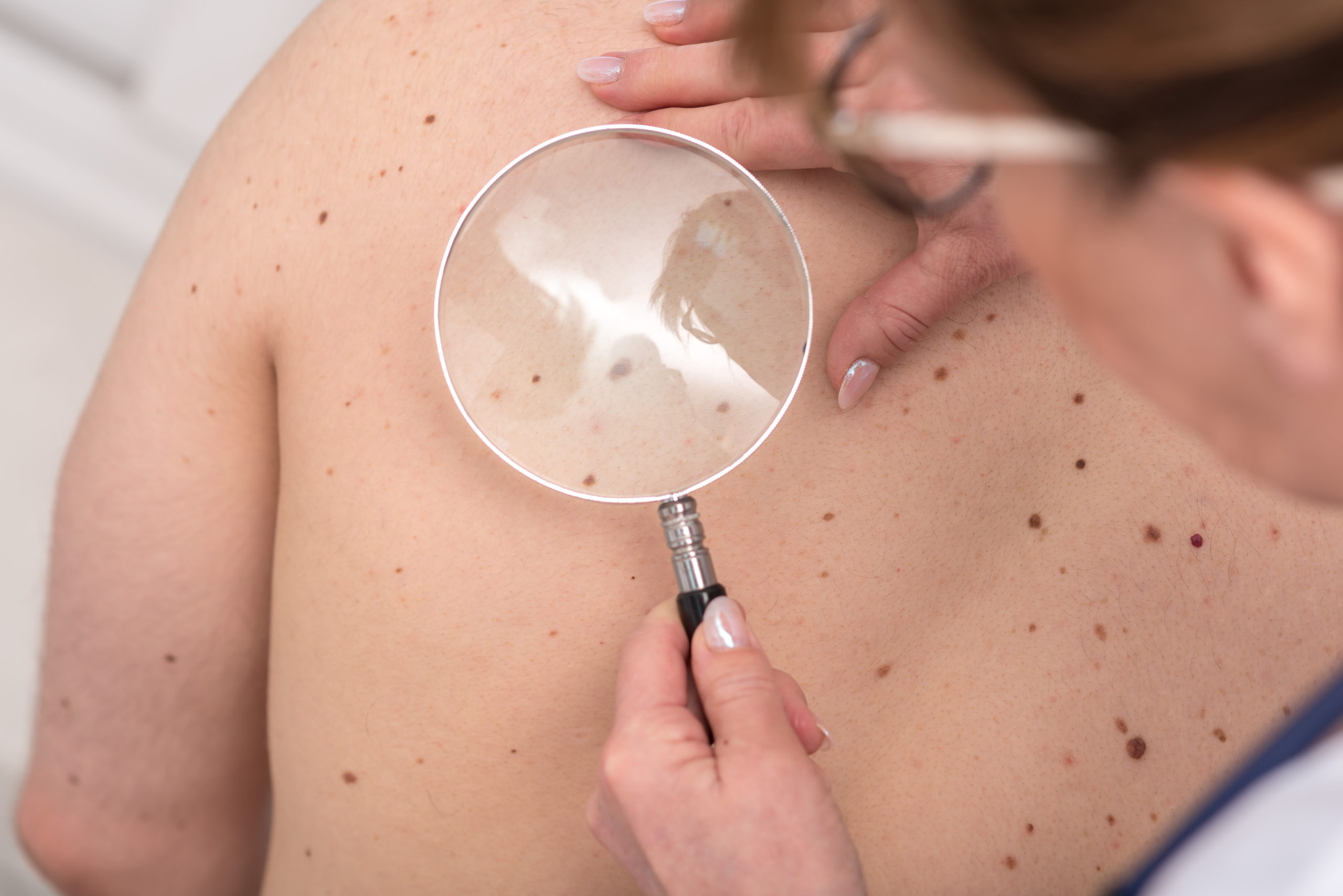melanoma