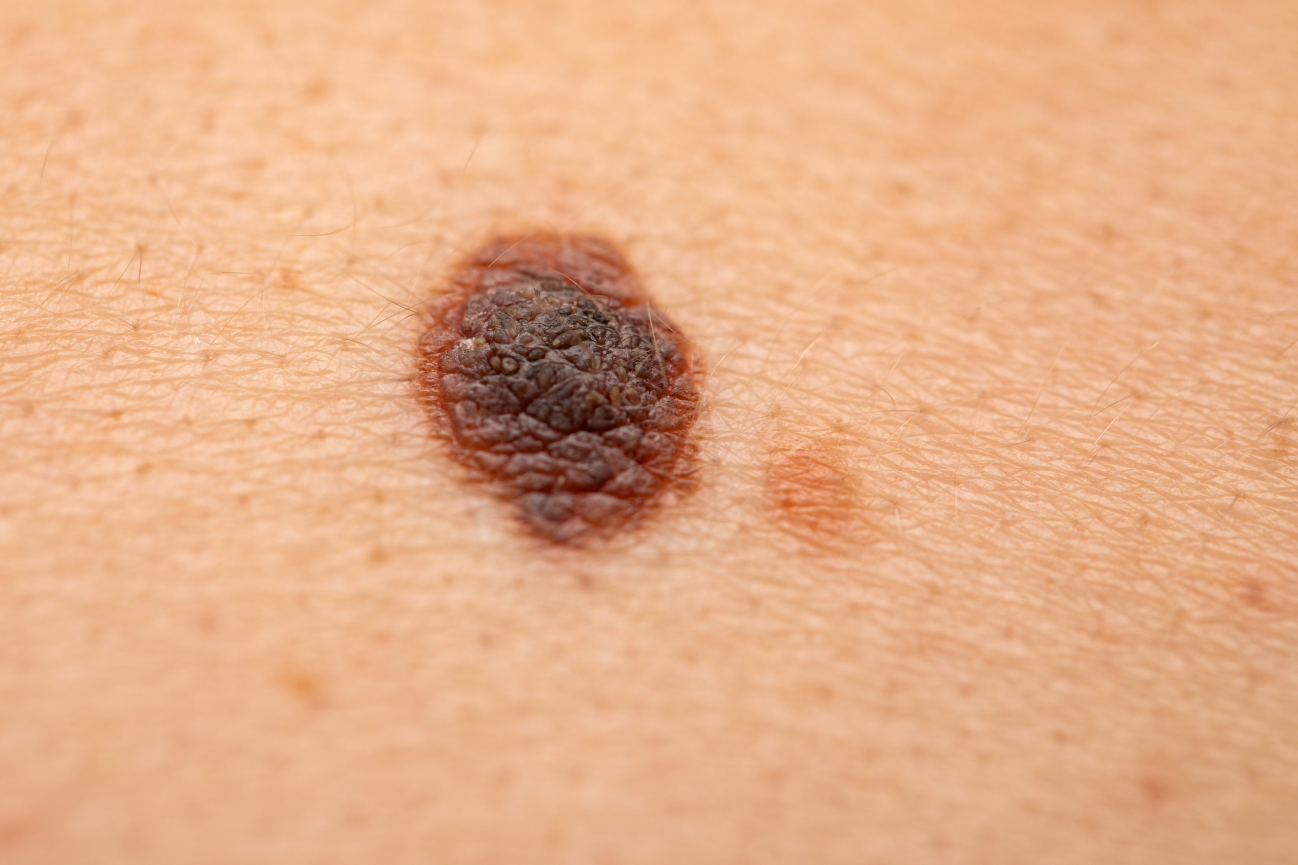 melanoma
