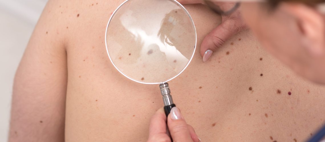 melanoma