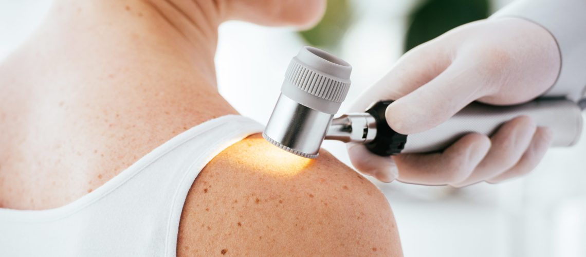 Melanoma