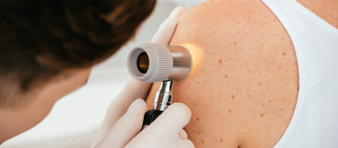Melanoma