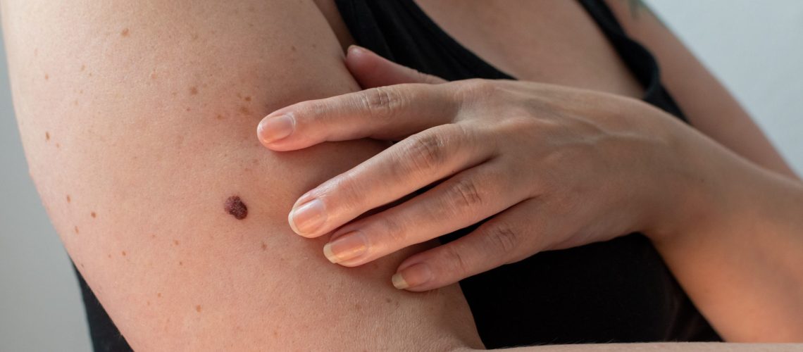 Melanoma