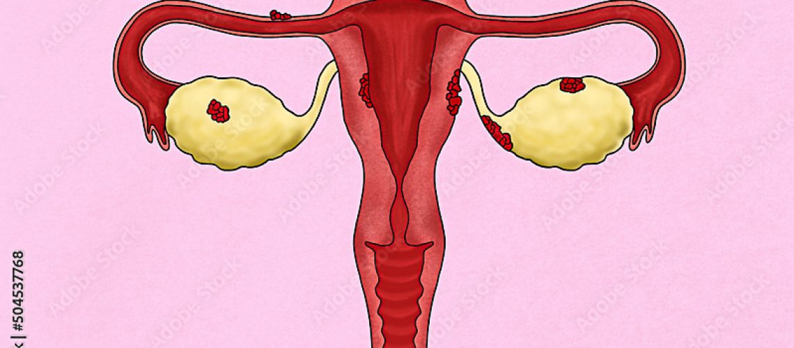 câncer-de-endométrio-causas-e-sintomas
