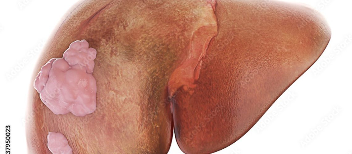 câncer-de-fígado-9-sinais-para-ficar-atento