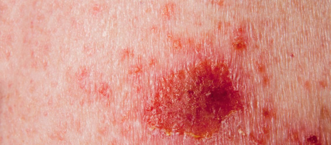 Carcinoma basocelular