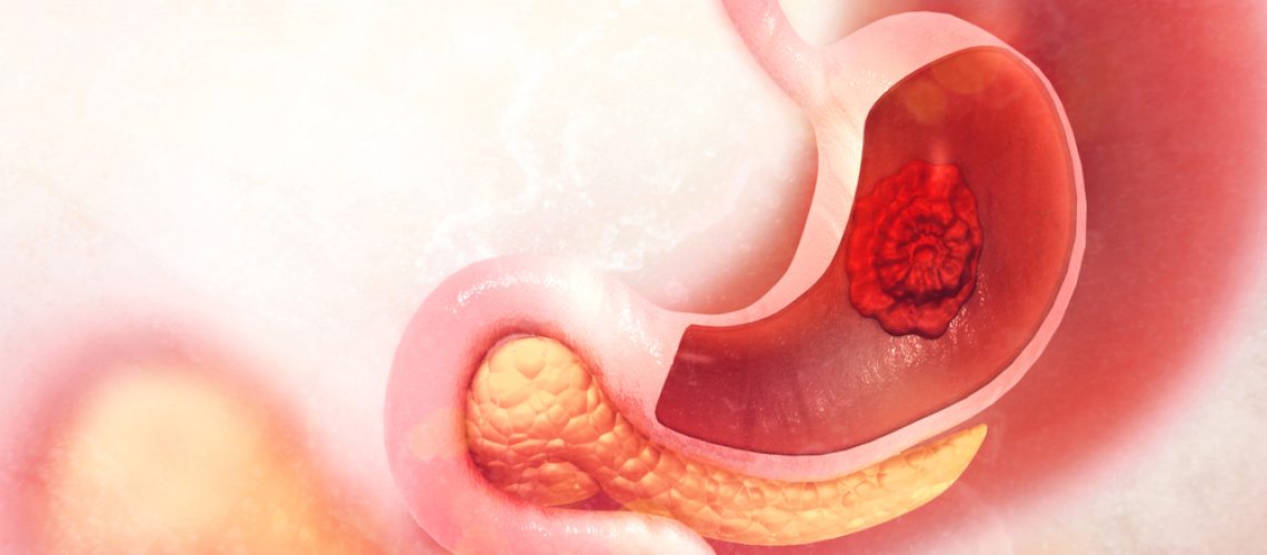 câncer gástrico