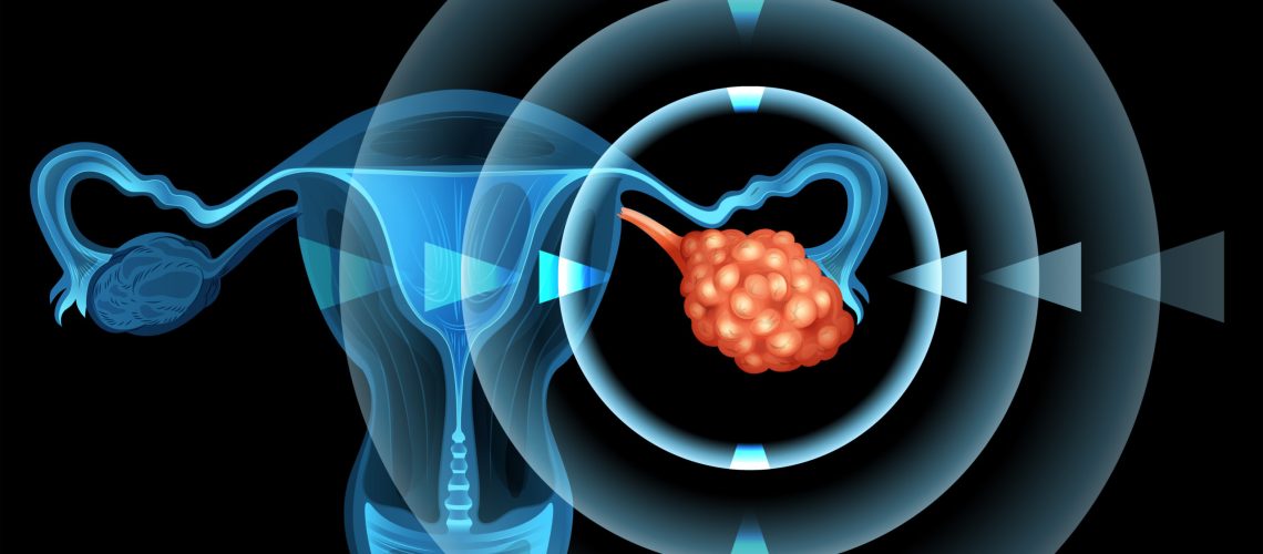 Cirurgia de câncer de ovário
