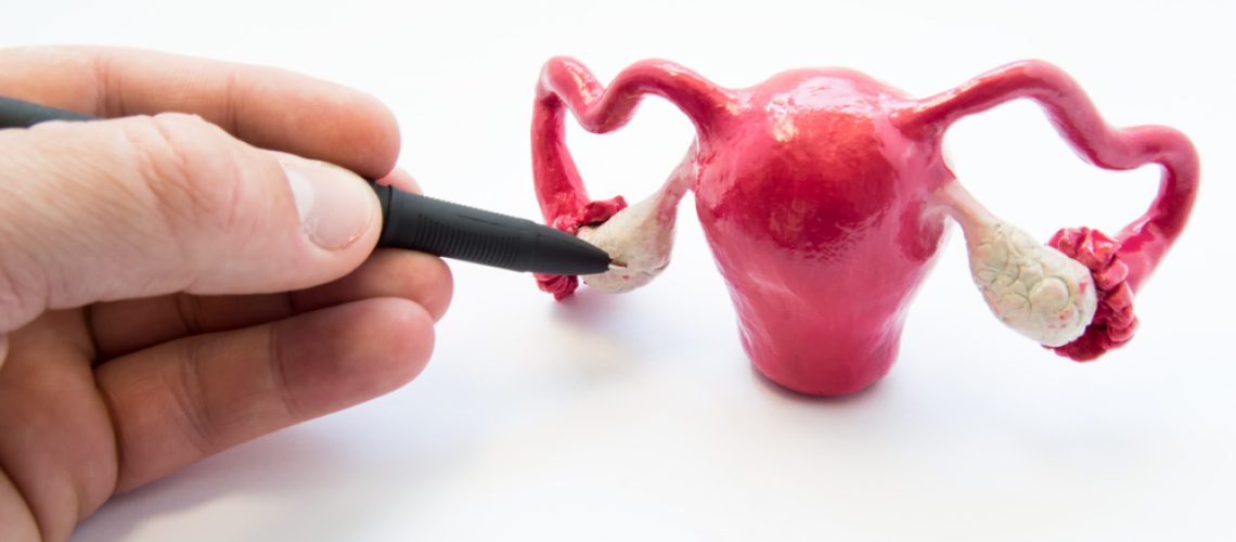 Cirurgia de câncer de ovário