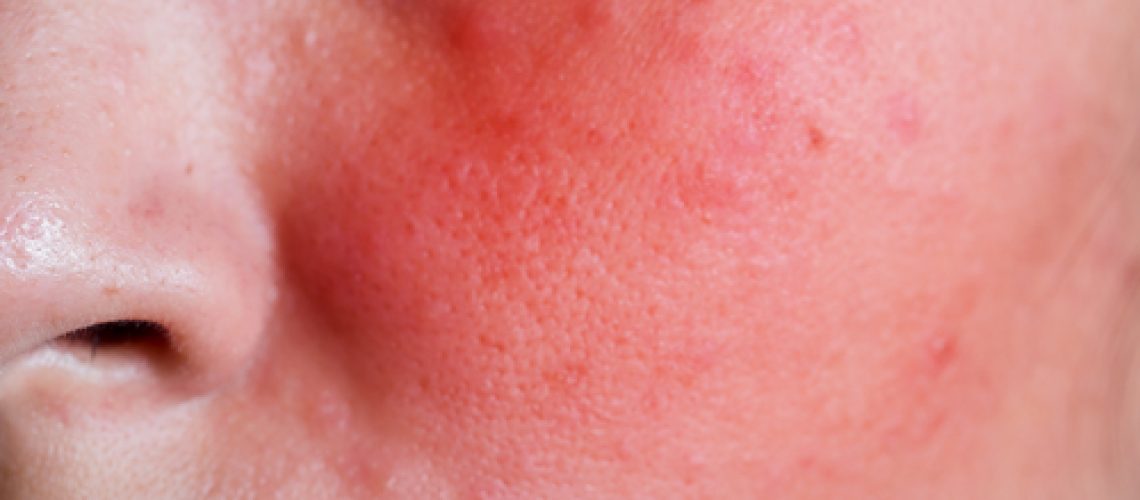 Carcinoma de células escamosas