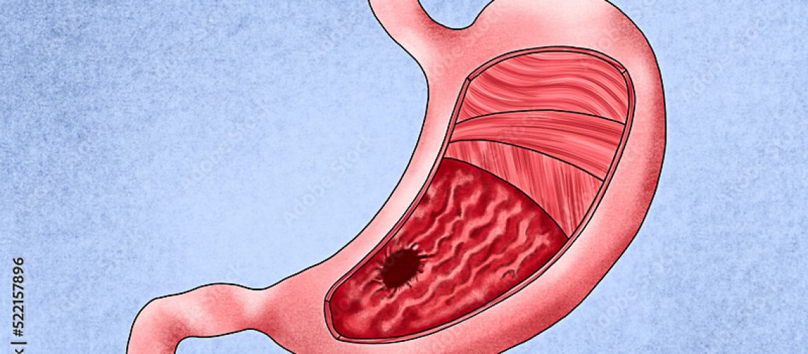 sinais-e-sintomas-que-podem-indicar-câncer-de-estômago